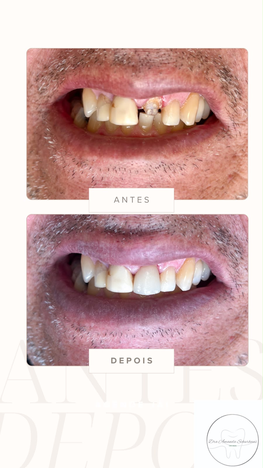 Caso clínico: antes e depois de prótese após perda dentária