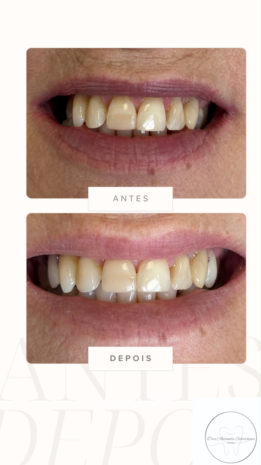 Caso clínico: antes e depois de restauração em dentes anteriores